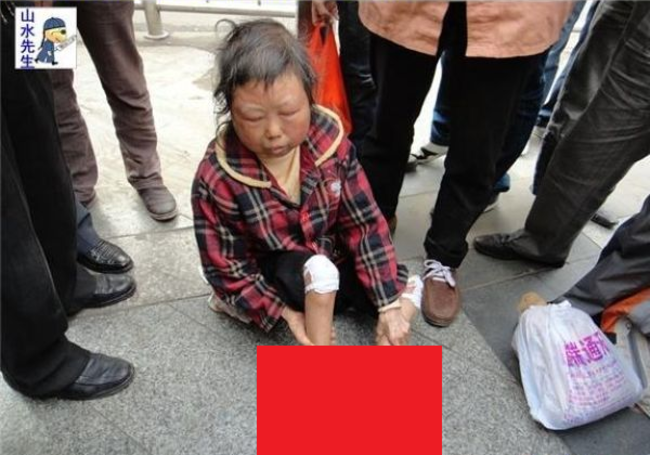 [b ] 【閲覧注意】中国で話題。路上で助けを求める足がミイラ化した48歳の女性 ポッカキット